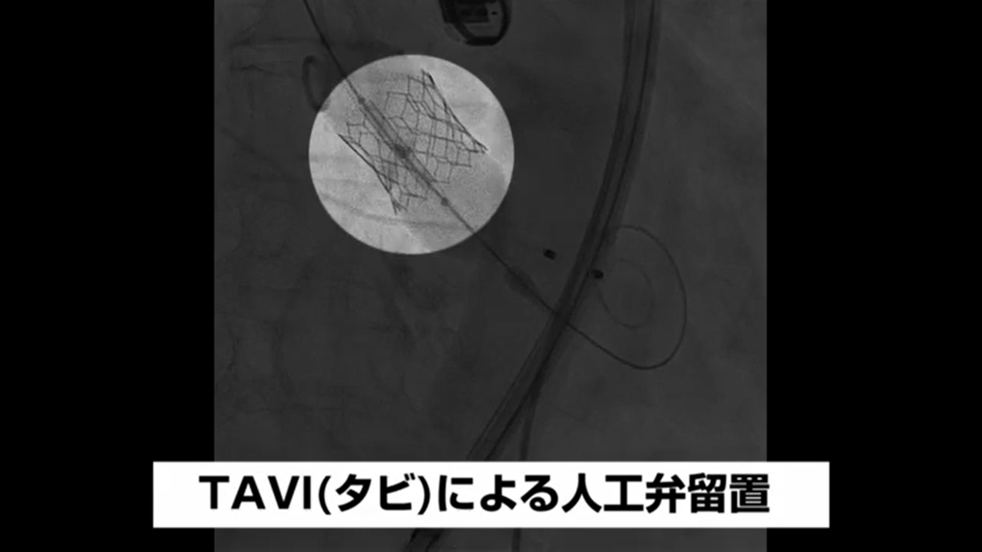 大動脈弁狭窄症の新しい治療法「TAVI（タビ）」